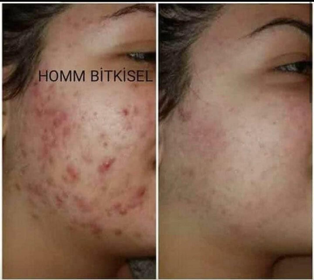 Homm Bitkisel Kombin